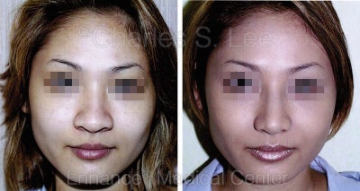 Nose - 
	Patient C View 1
