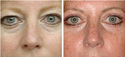 Blepharolplasty - 
	Eyelid Surgery
