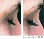 Latisse, before and after - 
	Latisse
