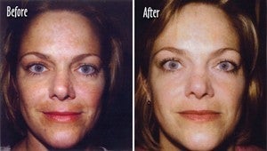  Microderm full face Before and After - 