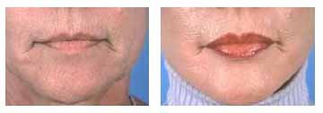 Lip augmentation with Alloderm implants - &nbsp;Lip Augmentation with Alloderm Implants