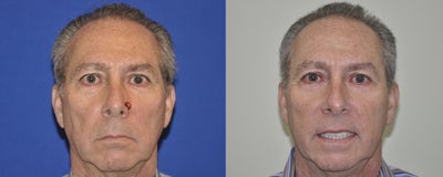 Skin Cancer Reconstruction of the Nose - 
	This gentleman had Mohs surgery (skin cancer excision) of his nose performed by a Mohs Surgeon and came to me for the reconstruction. I utilized a combination of an advancement flap and a rotation flap to repair the excision site. This was done under local anesthesia in the office and took approximately one hour. He is shown 3 months following the repair and is quite happy with his outcome.
