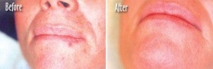  Microdermabrasion Chin and Mouth - 