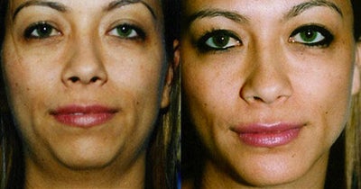 Chin Augmentation - 
	Considered rhinoplasty, but elected to undergo chin augmentation to achieve better facial proportion.
