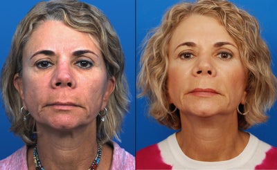 Ultherapy - 
	Ultherapy
