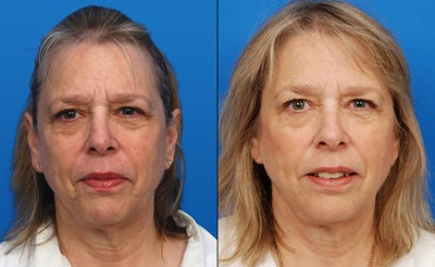Ultherapy - 
	Ultherapy
