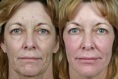Pearl Fractional - 
	52 yr old female was concerned about her lower face starting to sag and the lines and wrinkles that make her look unhappy. She had a PEARL treatment to smooth the overall texture of her skin, reduce brown spots and wrinkles, along with Thermage to tighten skin, Limelight for even coloration, Botox, Restlane, and Juvederm for correction of lines &amp; volumization.
