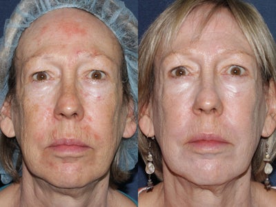 PDT - 
	1 Photodynaminic therapy treatment
