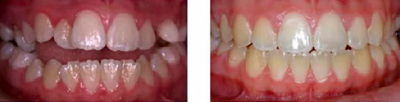 Braces - Open bite - 
	Open bite treated with orthodontic braces
