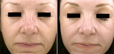 Pro-Fractional -
Pro-Fractional Laser
