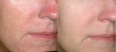 Photorejuvenation - 
	Redness from rosacea and pigmentation from sun exposure
