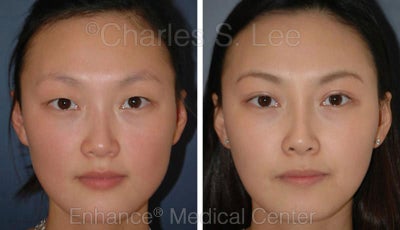 Blepharoplasty and Rhinoplasty - 
	Eyelid, Nose.
