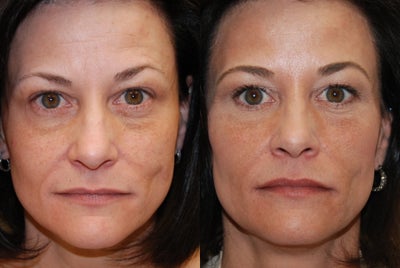 Non-surgical facial rejuvenation with Silikon-1000 and Botox. - 
	My patient requested non-surgical facial rejuvenation. These photos are 10 days following forehead Botox, and facial Silikon-1000 injections. Silikon-1000 was injected into her lower eyelid grooves, nasolabial folds and lips. You can see a youthful, natural-looking, attractive appearance. Her results with Silikon-1000 are permanent, and her Botox will require re-treatment in around 4 months.
