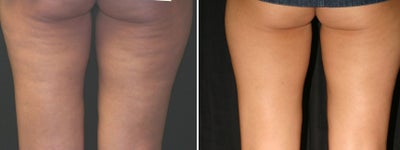 Acoustic Wave Therapy  to Thighs - 
	Image courtesy of Medsurge Advances, Procedure performed by Dr. Bill Johnson
