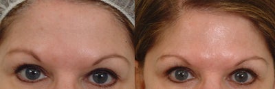 Pearl laser - Pearl laser-two treatments
