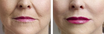  Collagen Injections - 