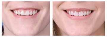 Alloderm facial implants for lip augmentation - 