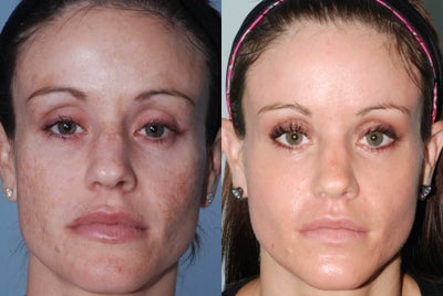 Fraxel Restore Dual Laser Treatments - 
	Treated with a single moderately aggressive treatment with Fraxel Restore Dual Laser.
