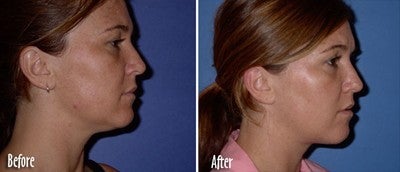 Mesotherapy to chin and jaw line - Skinovative USA