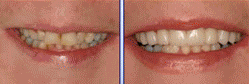 Veneers - 
	Fillings and Veneers
