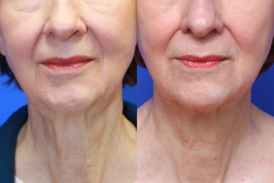 Exilis Skin Tightening - 
	Exilis results after six treatments.
