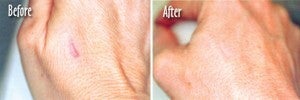 Microdermabrasion of Scars on Hands - 