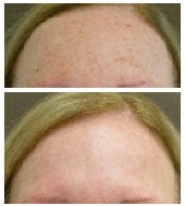 Pixel and Qs Alexandrite laser treatment - 58 year old female patient treated with Pixel and Qs Alexandrite laser for treatment of brown spots and photodamage