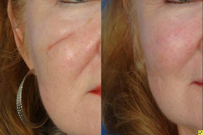 Scar Revision Surgery - 
	This patient presented with a long depressed scar on her right cheek. She underwent excision with a geometric broken line closure followed by dermabrasion 6 weeks later.
