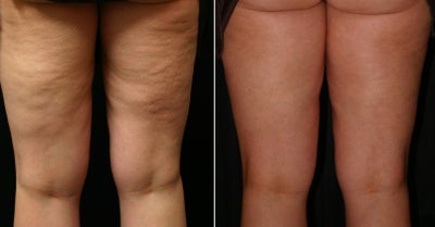 Acoustic Wave Therapy  to Thighs - 
	Image courtesy of Medsurge Advances, procedure performed by Dr. Bill Johnson
