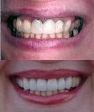 Porcelain crowns - Porcelain crowns before and after