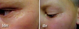  Microdermabrasion Scar Repair - 