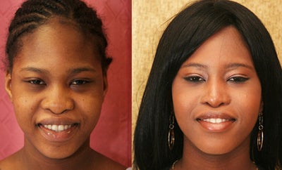 Rhinoplasty- African American - 
	African American rhinoplasty or nose surgery.
