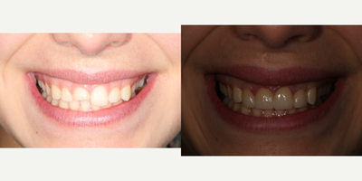25-34 year old woman treated with Tooth Repair - Tooth fracture can be replaced with veneers or crowns.