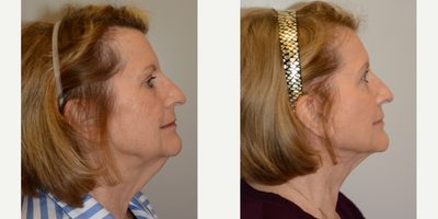 65-74 year old woman treated with Facelift - Patient's surgery included a Facelift, Fat Transfer to the Fact and Lower Blepharoplasty