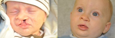 cleft lip repair - before and after picture for cleft lip repair
