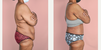 55-64 year old woman treated with Tummy Tuck, Tumescent Liposuction - This patient lost a significant amount of weight and developed loose skin which she wanted removed. She underwent a tummy tuck and liposuction procedure and is shown 2 months post-op.