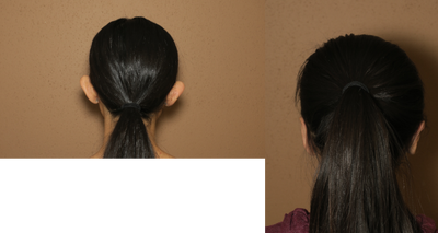 17 or under year old woman treated with Ear Surgery - otoplasty
