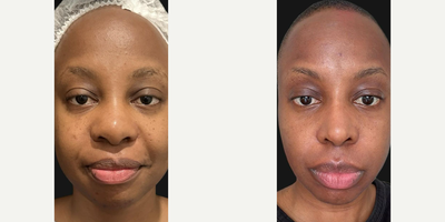 Woman treated with Rhinoplasty, African American Rhinoplasty - Our fabulous patient from Belgium is shining 1 year post-op! Her fillers and naturally thicker skin meant that a longer healing time was expected, sometimes taking up to 2 years. However, after just 1 year, shes already looking wonderful, showcasing elegant results and proving that patience truly pays off.