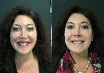 Woman treated with Dermal Fillers - Woman treated with Dermal Fillers