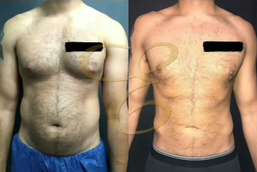 Man treated with Vaser Liposuction - Man treated with Vaser Liposuction