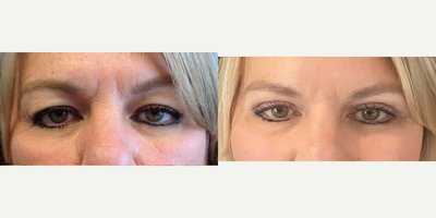 55-64 year old woman treated with Eyelid Surgery - Upper bleph and brow pexy opened this patients eyes and provide a more youthful appearance. She is still healing, but results look fantastic only one month post-op.