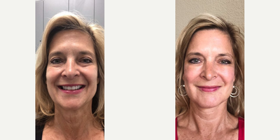 Woman treated with Bellafill - Here at Beyond Beautiful we care about our patients experience far past a simple before and after photo, which is why we provide real feedback from patients post-procedure. Here is Kims 1-week update after her FB LIVE Bellafill treatment.