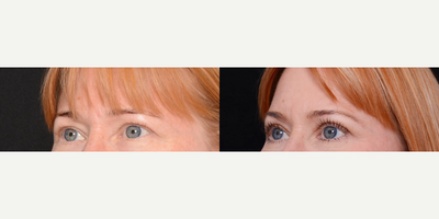 Woman treated with Brow Lift - Are you searching for a way to do away with sagging brows and replace it with a smoother, wrinkle-free forehead? Its time to ditch droopy eyebrows! A Brow Lift is a fantastic solution to refresh your face for those who are looking for results that last longer than Botox. Dr.Ho is a double board certified facial plastic surgeon who uses the latest techniques to allow this procedure to be completed in a relatively short period of time on an outpatient basis.