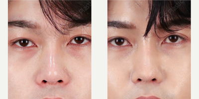 25-34 year old man treated with Asian Rhinoplasty, Cheekbone Reduction, Jaw Reduction - [Facial Contour]- Cheekbone Reduction*We have used our special technique; Dual fixation-Chin reduction[Rhinoplasty]- Open RhinoplastyBecause he had a short nose, we extended the septal graft and had the nasal tip repositioned, and sutured.