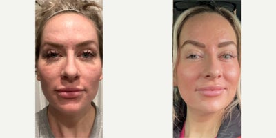 25-34 year old woman treated with Halo Laser, CO2 Laser - So, our client had some acne scars on her face and deeper ones on her nose from cystic acne.We hit it with a mix of Halo, CO2, and topped it off with our special EMER cocktail: Anteage Exosomes, PRP, and our EMER Skin Intense Hydration mask. Her skin is glowing!No skincare routine is complete without EMER SKIN. Our post-treatment products? They're really the cherry on top, taking results to the next level. Plus, lots of our clients love pampering their skin post-treatment.She loved the amount of improvement we achieved with this round of treatments and she cannot wait to do more in the near future.To schedule a consultation for ACNE SCARS: