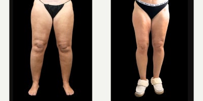 45-54 year old woman treated with Lipedema Surgery, Liposuction - Once a competitive figure skater and volleyball player, Dr. Arias stage 2 patient worked out 3-4 hours daily. And despite also struggling with an eating disorder, her lower body remained unchanged due to Lipedema.Now, 6 months after surgery with Dr. Aria, she is pain free and so much more comfortable in her own skin. Now she feels the confidence to wear shorts and knee high boots.
