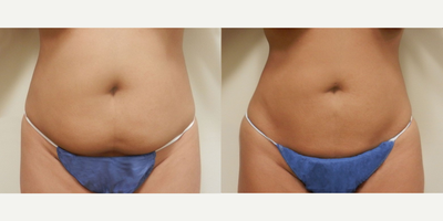 Woman treated with Liposuction - Woman treated with Liposuction
