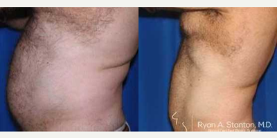 Woman treated with Liposuction - Woman treated with Liposuction