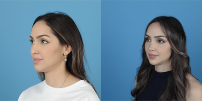 25-34 year old woman treated with Revision Rhinoplasty - Revision Rhinoplasty, breathing problems fixed, nose hump removed, nose tip corrected and elevated