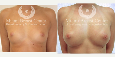 18-24 year old woman with Breast Augmentation using fat grafting - 24 year old woman with breast augmentation using fat grafting to achieve fuller, natural and implant-free breasts.